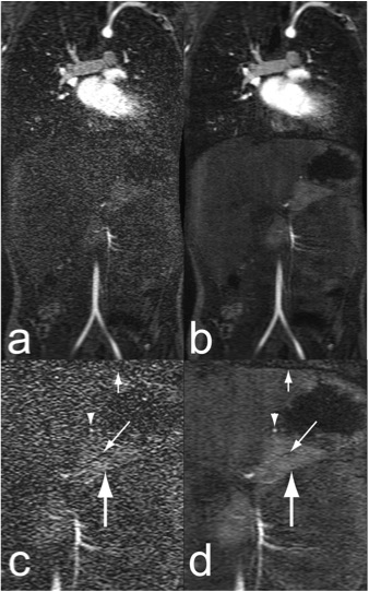 Fast MRI techniques