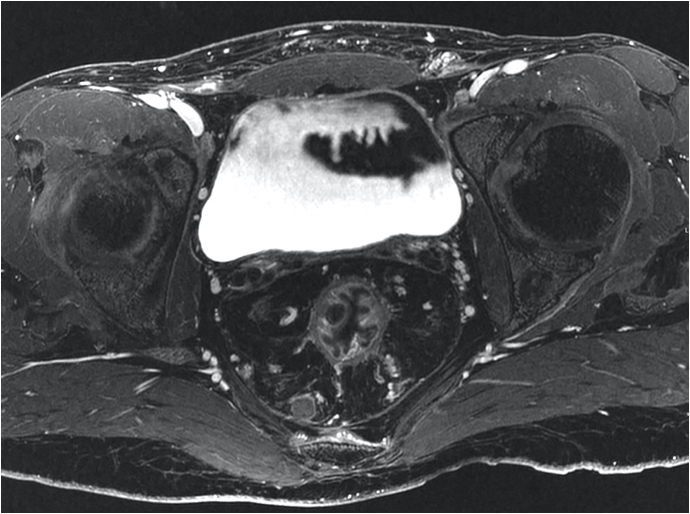 inflammatory bowel diesease