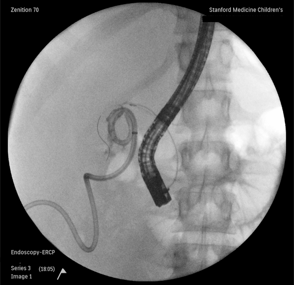 ercp
