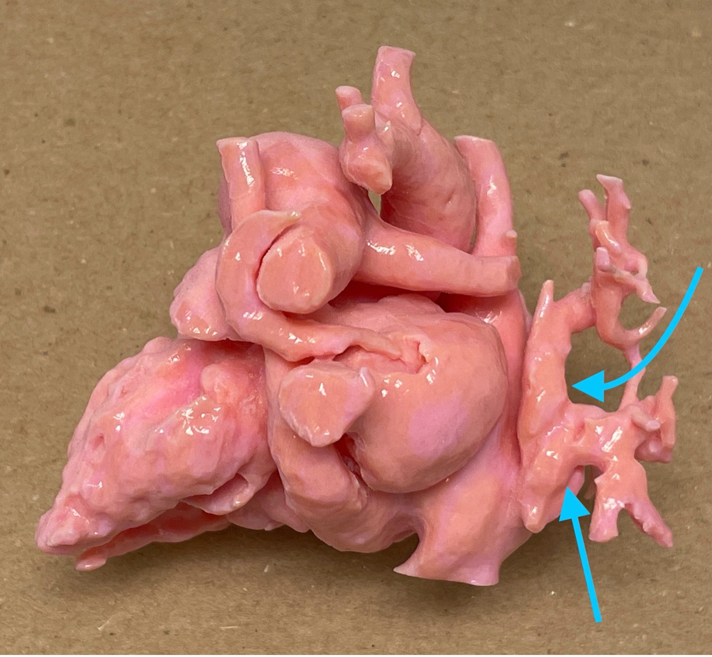 3D printing from a cardiac MRI in a child with partial anomalous pulmonary venous return (blue arrows)